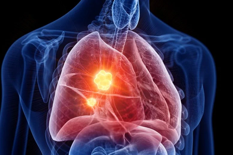 Marijuana use may increase lung cancer risk, researchers warn