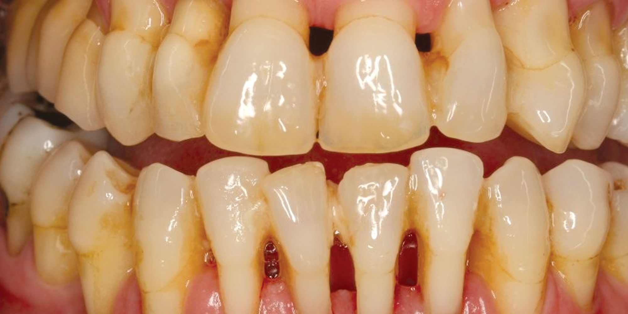 How a tropical fruit gel could help treat severe gum disease
