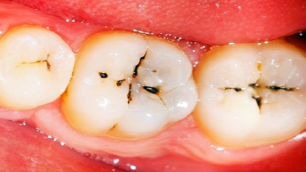 Scientists discover simple treatment that could stop cavities without drilling