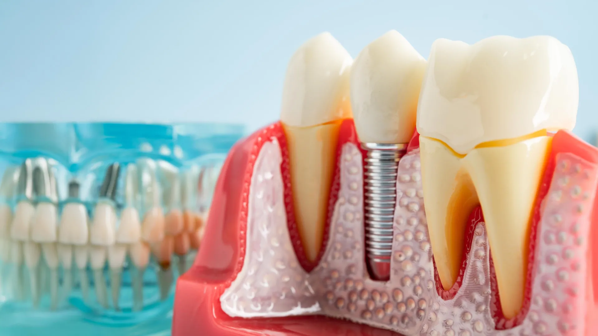 Dental implants may weaken immune response and worsen infections, study finds